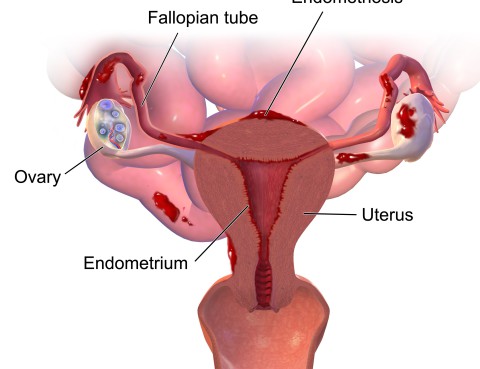 Endometriosis y Robotica